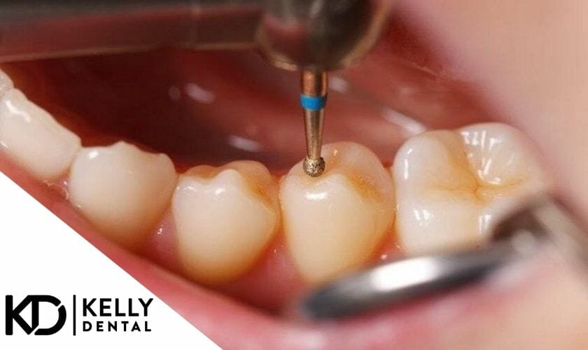 Dental Fillings Springfield