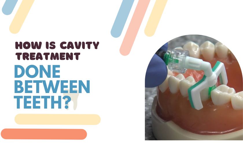 Cavity Treatment
